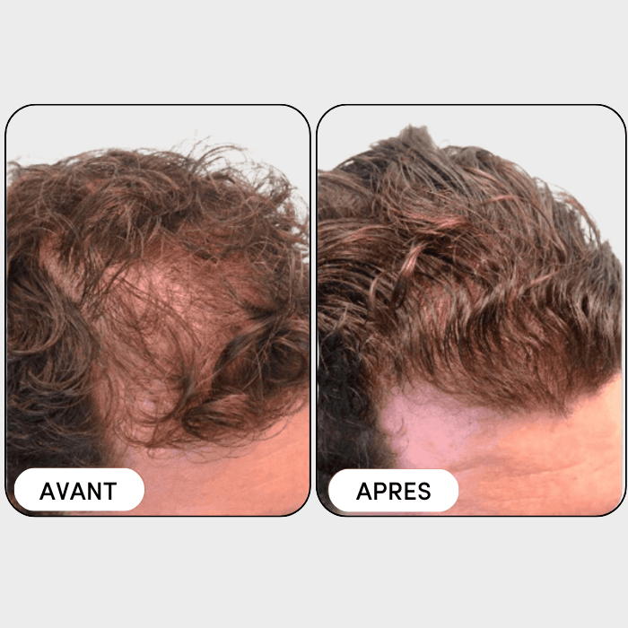 Shampooing Activateur Follicare - Follicare